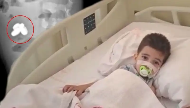Hayat Kurtaran Müdahale: Pil ve Mıknatıs Yutan Çocuğun Bağırsağı Yanmıştı